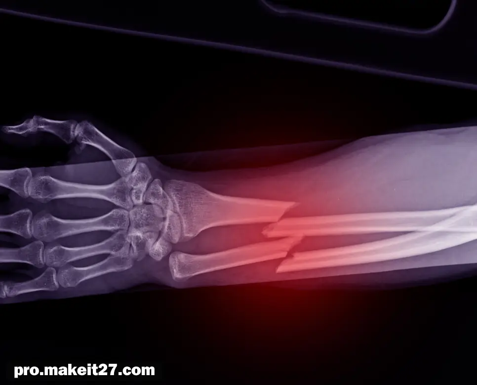 FX 의학용어, PAOD 의학용어, SPN 의학용어