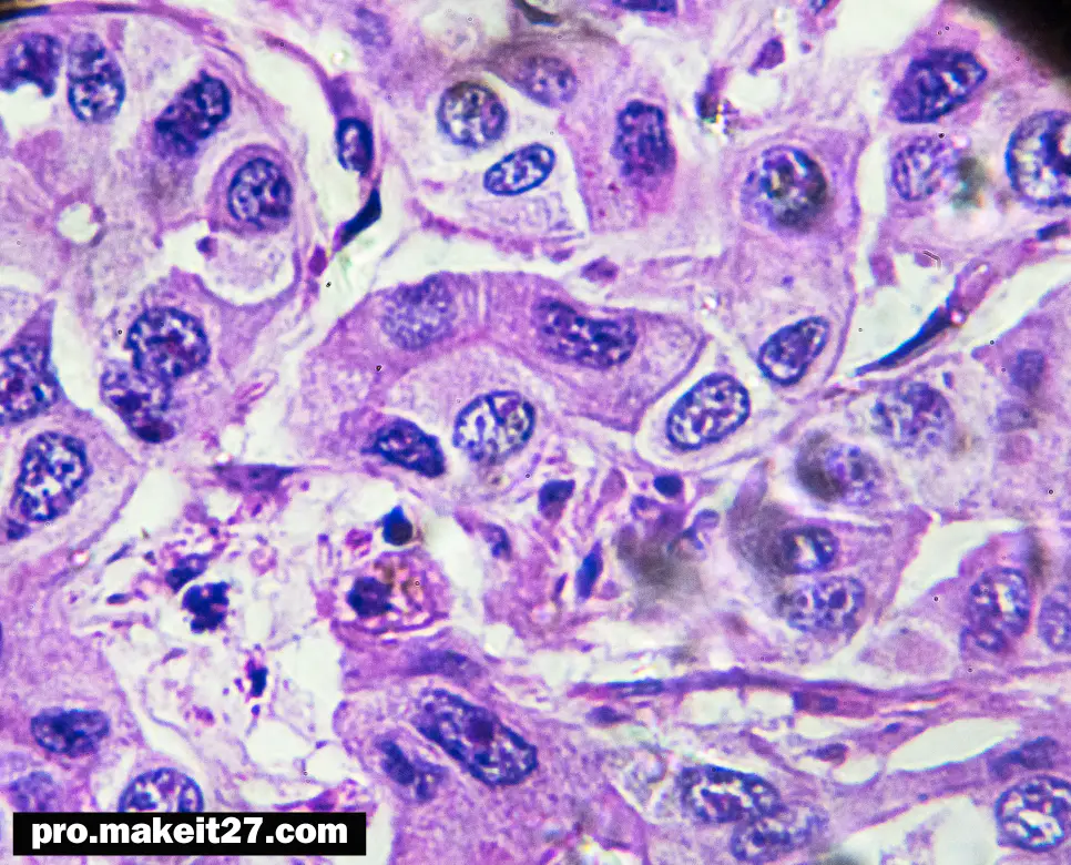 HCC 의학용어, DOA 의학용어, PTE 의학용어