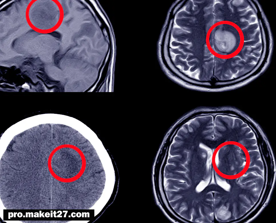 ICH 의학용어, PCN 의학용어, NE 의학용어
